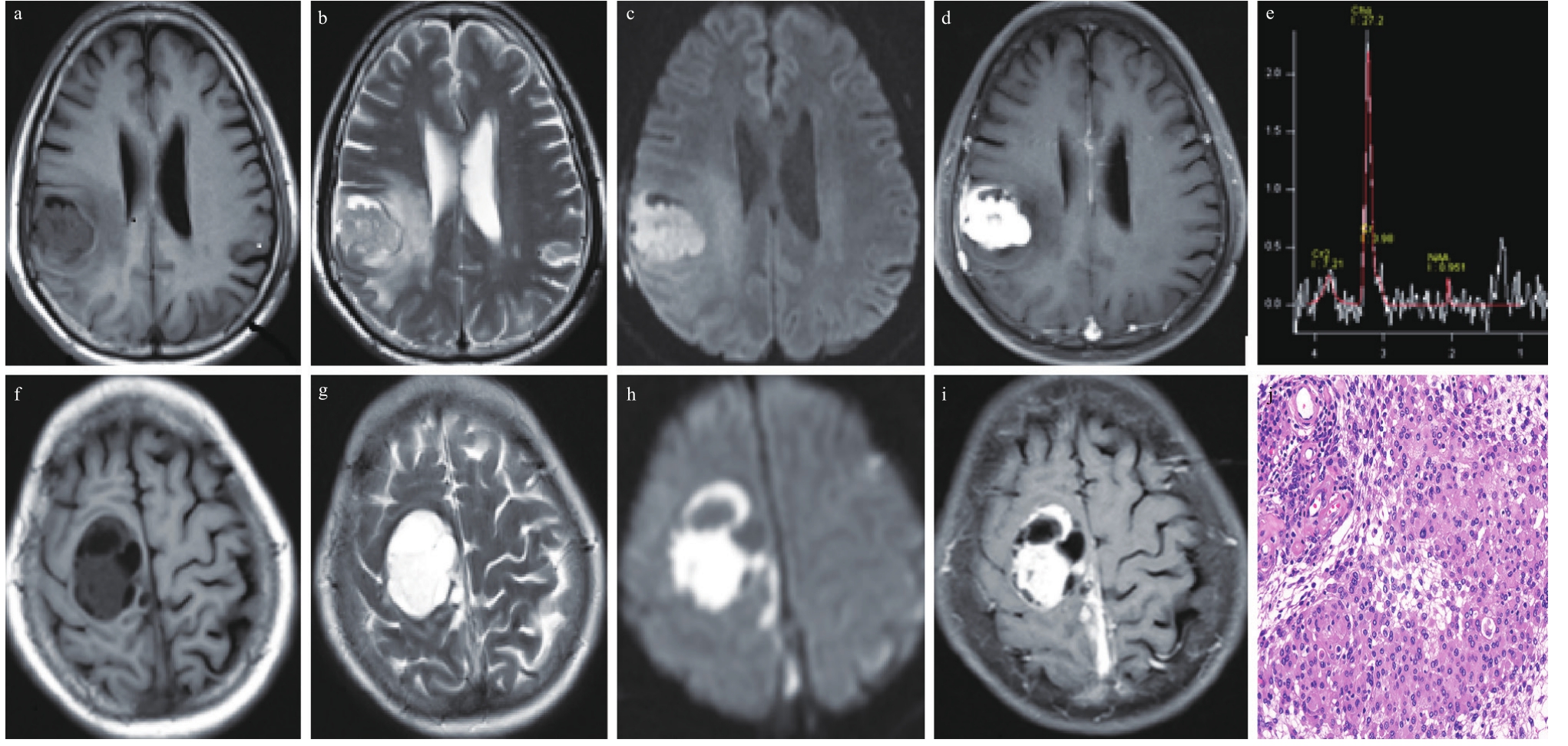 MR图谱 | 放射性脑损伤vs胶质瘤复发-INC国际神经外科医生集团