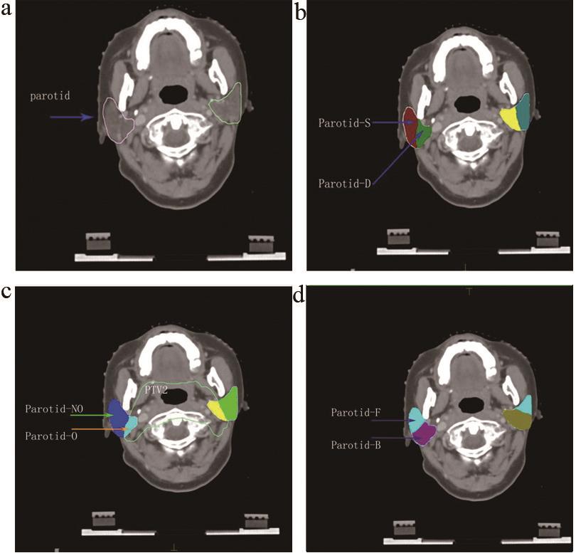 腮腺分区勾画方式对鼻咽癌imrt计划靶区及腮腺剂量的影响